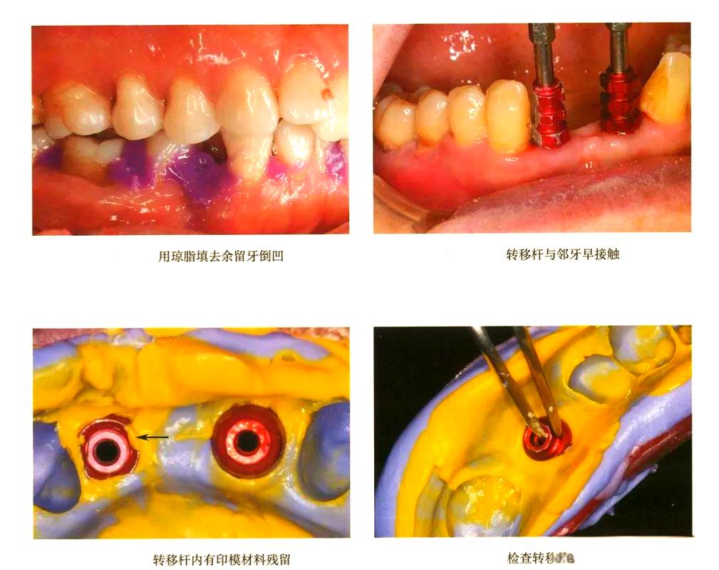 种植修复印模方法如何分类?常见分类标准及临床意义?-图1 种植修复印模方法如何分类?常见分类标准及临床意义?-图1