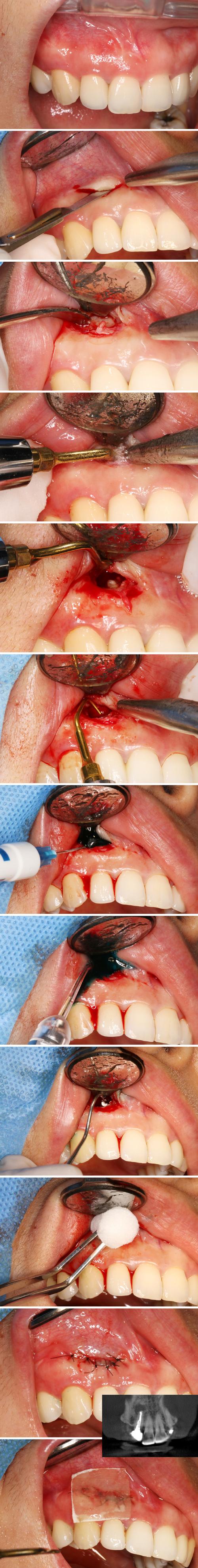 牙周改良隧道手术方法-图2 牙周改良隧道手术方法-图2