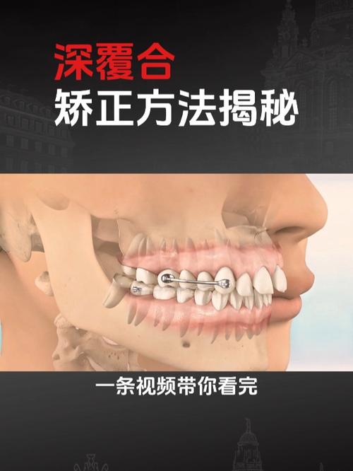正畸打开深覆合咬合，有哪些常用安全有效方法及适用人群？-图3