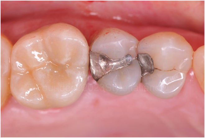 后牙折的修复治疗方法-图3