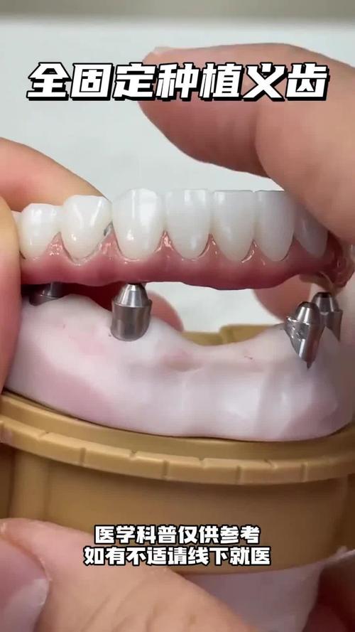 种牙手术后旁边牙活动,是何原因?-图1 种牙手术后旁边牙活动,是何原因?-图1