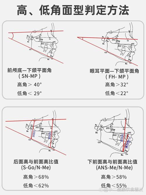 口腔正畸ANB角是什么？测量意义何在？-图3
