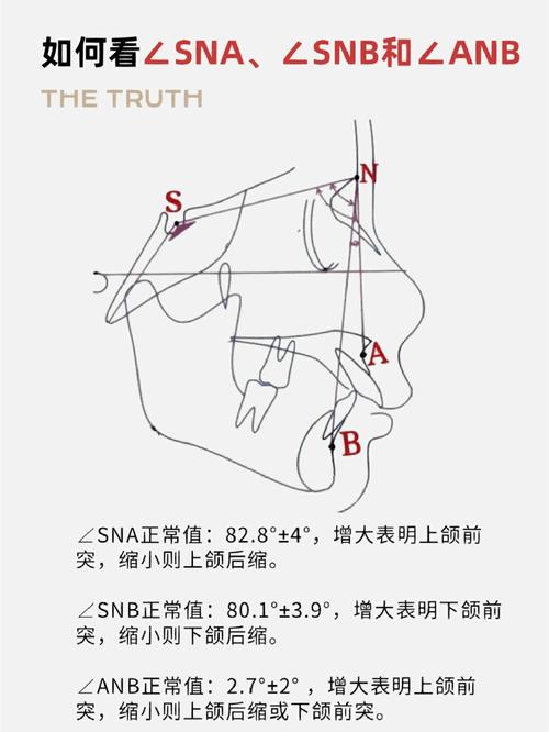 口腔正畸ANB角是什么？测量意义何在？-图2