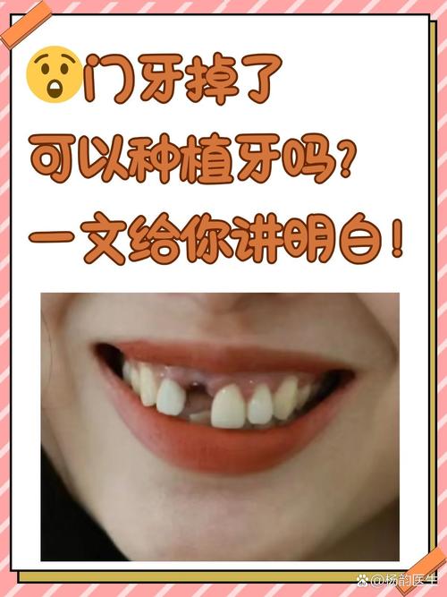 牙脱落后多久可以种牙-图3 牙脱落后多久可以种牙-图3