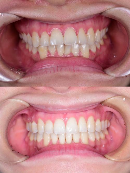 拜博口腔牙齿矫正-图3 拜博口腔牙齿矫正-图3