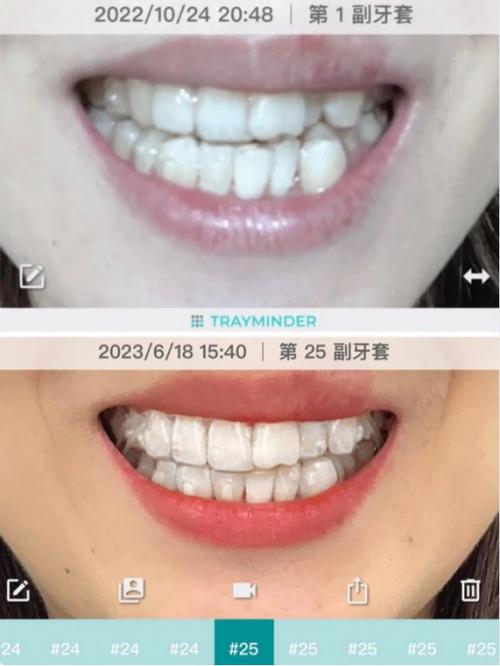 如何正确佩戴时代天使双膜？-图2