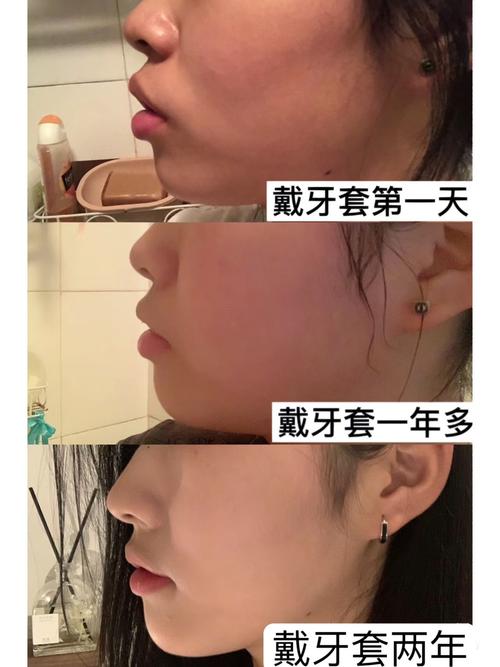 牙齿正畸特别突前后对比-图2 牙齿正畸特别突前后对比-图2