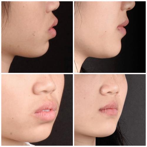 牙齿正畸特别突前后对比-图1 牙齿正畸特别突前后对比-图1