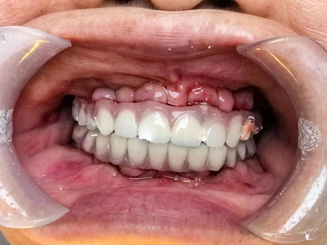 种牙期间临时牙能用吗-图2 种牙期间临时牙能用吗-图2