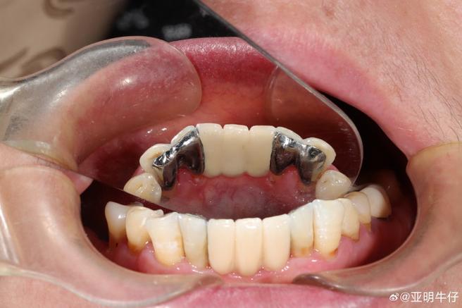 老年缺牙 镶牙 种牙-图1 老年缺牙 镶牙 种牙-图1