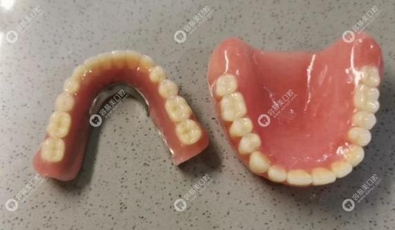 老年缺牙 镶牙 种牙-图3 老年缺牙 镶牙 种牙-图3