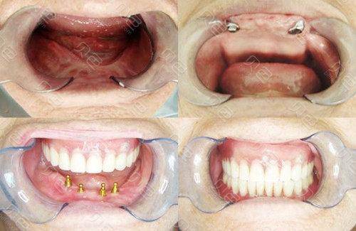 老年缺牙 镶牙 种牙-图2