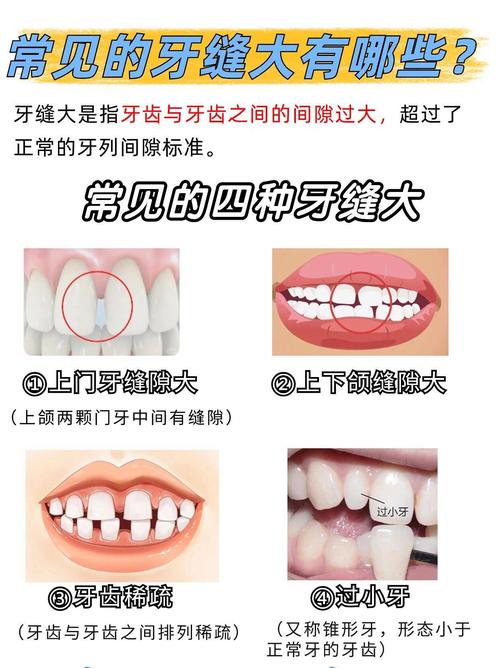 牙齿有缝隙用什么方法-图3