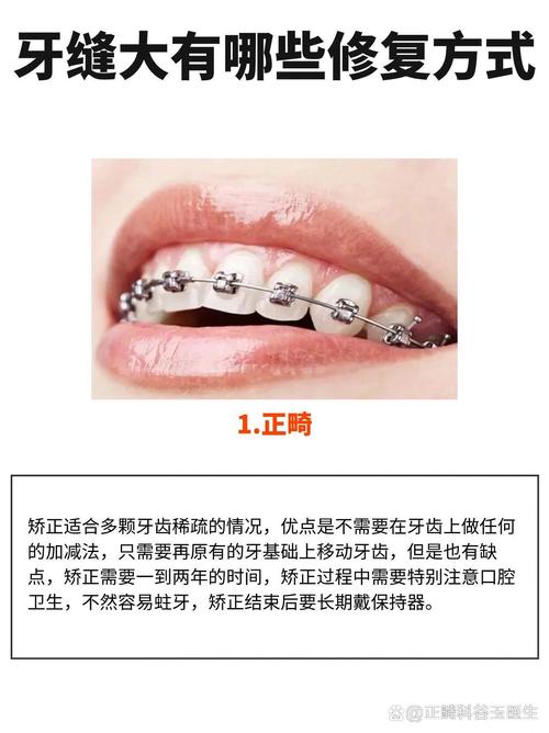 牙齿有缝隙用什么方法-图1