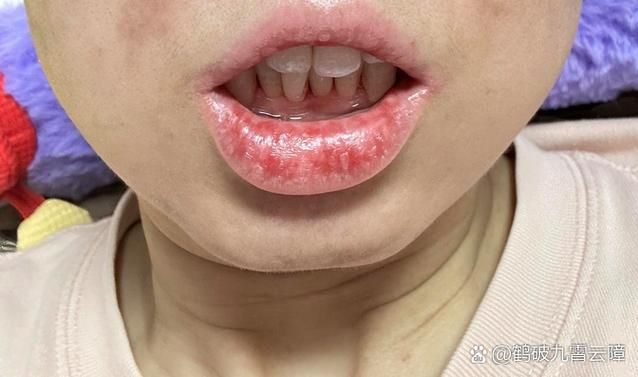 正畸支抗钉后脸肿化脓？怎么回事？原因是什么？-图1