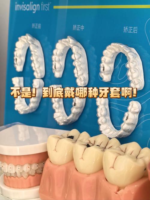 拜博口腔的时代天使矫正服务如何?效果和口碑真的值得信赖吗?-图3 拜博口腔的时代天使矫正服务如何?效果和口碑真的值得信赖吗?-图3