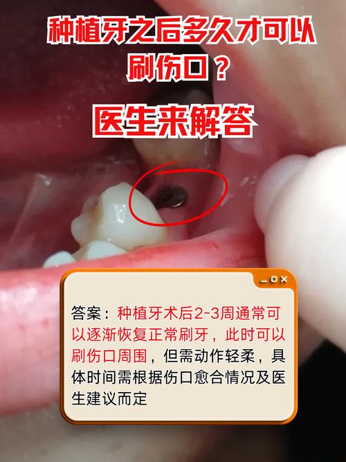 种牙第三天可以刷牙吗-图3 种牙第三天可以刷牙吗-图3