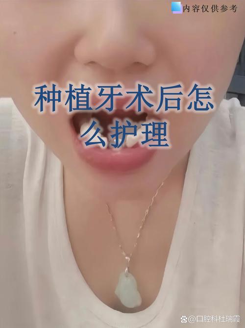 种牙第三天可以刷牙吗-图1 种牙第三天可以刷牙吗-图1