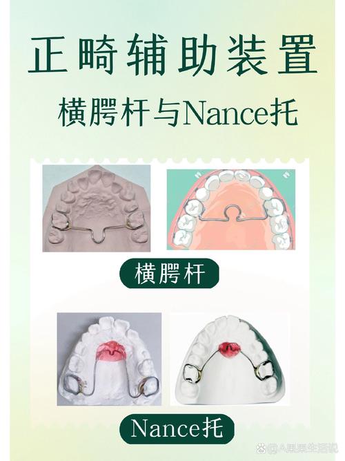 正畸nance托怎么玩-图1 正畸nance托怎么玩-图1
