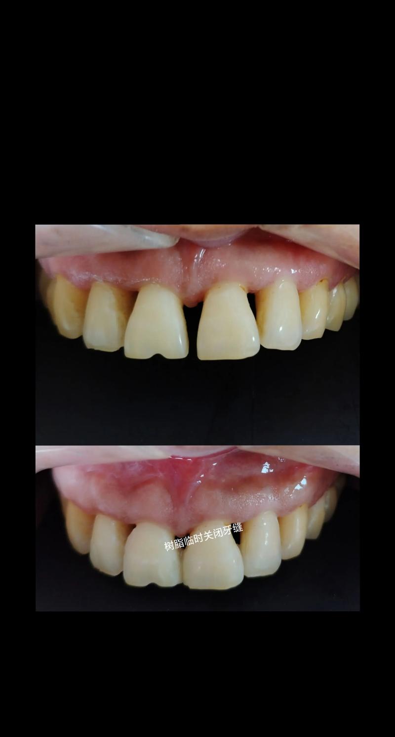 牙周炎手术有几种方法-图2