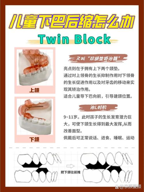 正畸TB与SGTB的区别究竟是什么?关键差异点及临床应用解析?-图1 正畸TB与SGTB的区别究竟是什么?关键差异点及临床应用解析?-图1
