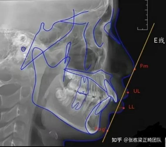牙科X光拍摄角度怎么选?方法步骤与不同牙位应用技巧-图2 牙科X光拍摄角度怎么选?方法步骤与不同牙位应用技巧-图2