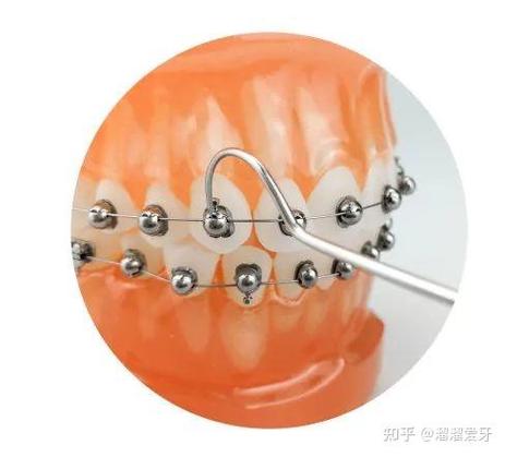 正畸为何选ormco自锁托槽？优势究竟在哪？-图2