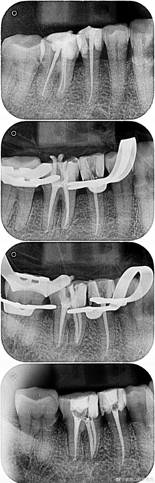 根管治疗钙化，最佳方法究竟如何确定？-图1