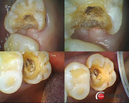根管治疗钙化，最佳方法究竟如何确定？-图2