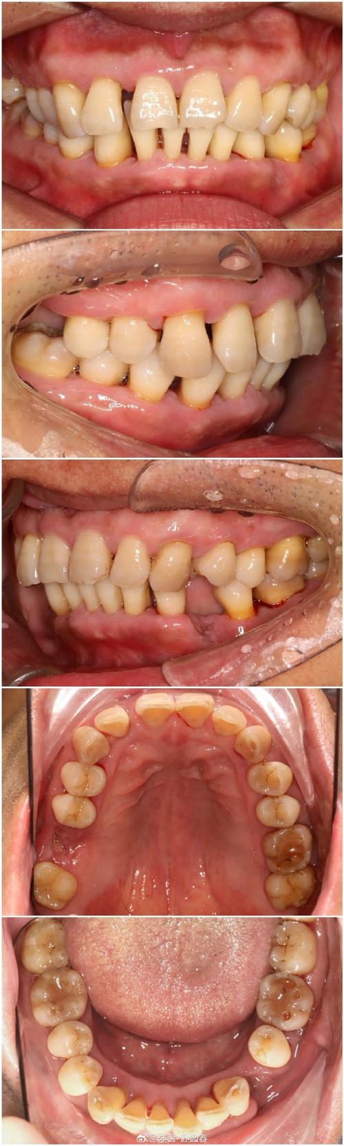 正畸期间发现牙周病,矫正会加重病情吗?如何兼顾治疗?-图1 正畸期间发现牙周病,矫正会加重病情吗?如何兼顾治疗?-图1
