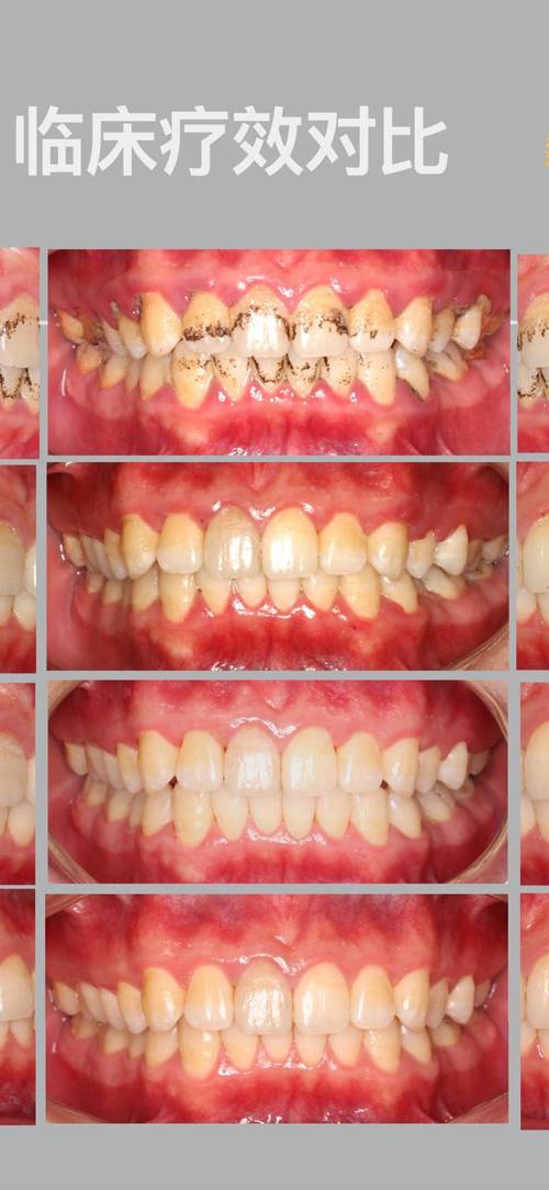 正畸期间发现牙周病,矫正会加重病情吗?如何兼顾治疗?-图2 正畸期间发现牙周病,矫正会加重病情吗?如何兼顾治疗?-图2