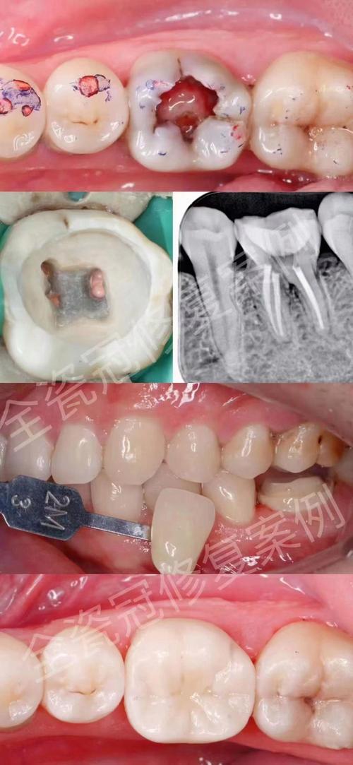 根管治疗后，这颗牙还能不能种牙呢？-图1