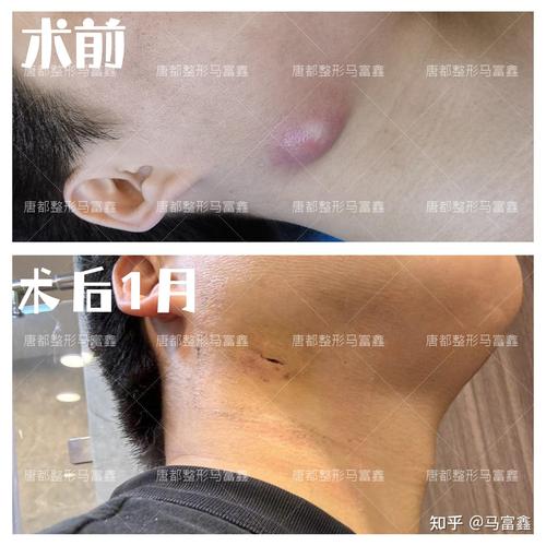 下巴囊肿怎么治疗方法-图3 下巴囊肿怎么治疗方法-图3