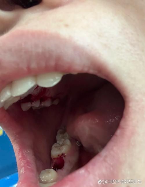 拔牙后隔2年种牙行吗-图3