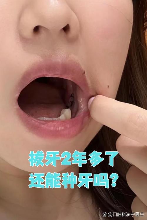 拔牙后隔2年种牙行吗-图1 拔牙后隔2年种牙行吗-图1