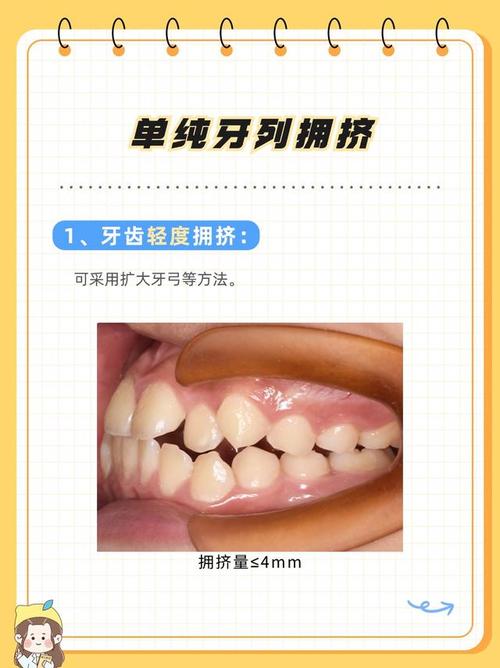 正畸牙齿拥挤程度分类有哪些依据?不同分类的正畸治疗方法有何不同?-图2 正畸牙齿拥挤程度分类有哪些依据?不同分类的正畸治疗方法有何不同?-图2