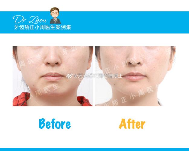 angel医生的正畸贡献具体体现在哪些核心技术与方法创新上?-图3 angel医生的正畸贡献具体体现在哪些核心技术与方法创新上?-图3