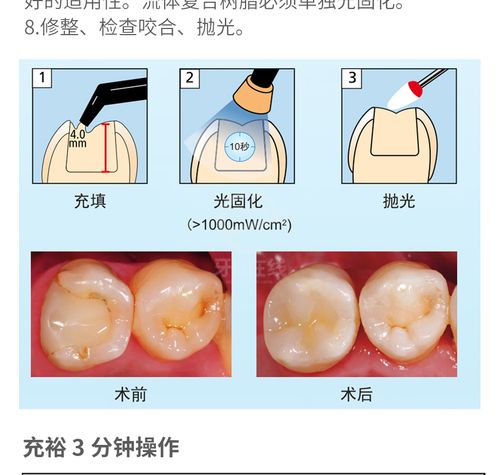 大块充填树脂使用方法-图1 大块充填树脂使用方法-图1