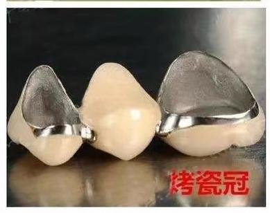 种牙后牙冠选什么材质?不同材质优缺点如何挑选合适?-图3 种牙后牙冠选什么材质?不同材质优缺点如何挑选合适?-图3