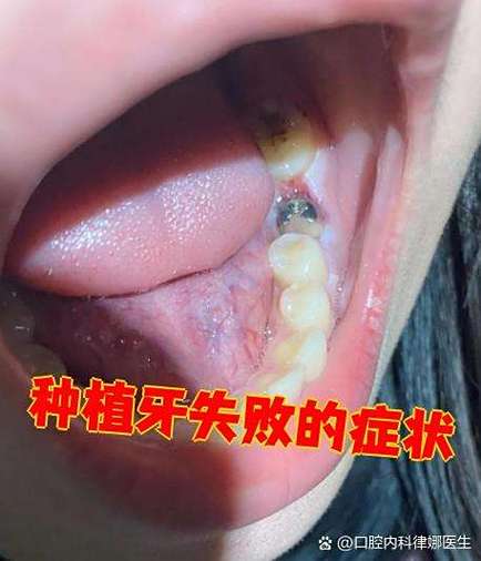 刚种完牙后会有哪些常见症状？-图2