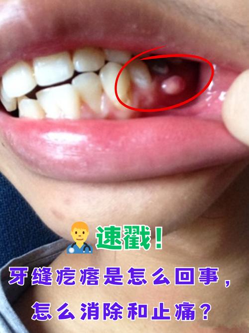 刚种完牙后会有哪些常见症状？-图3