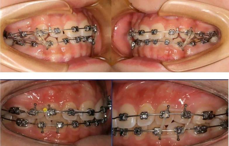 开颌正畸牙齿牵引方法-图2 开颌正畸牙齿牵引方法-图2