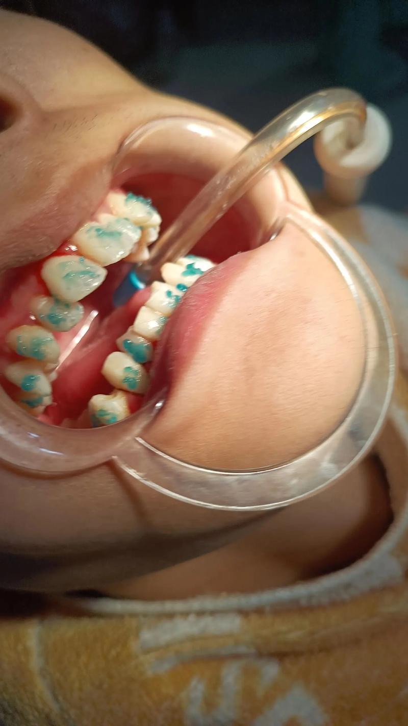 dolphin正畸视频-图1 dolphin正畸视频-图1