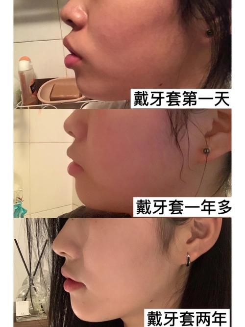 中外正畸有何不同?技术理念效果差异大吗?-图1 中外正畸有何不同?技术理念效果差异大吗?-图1