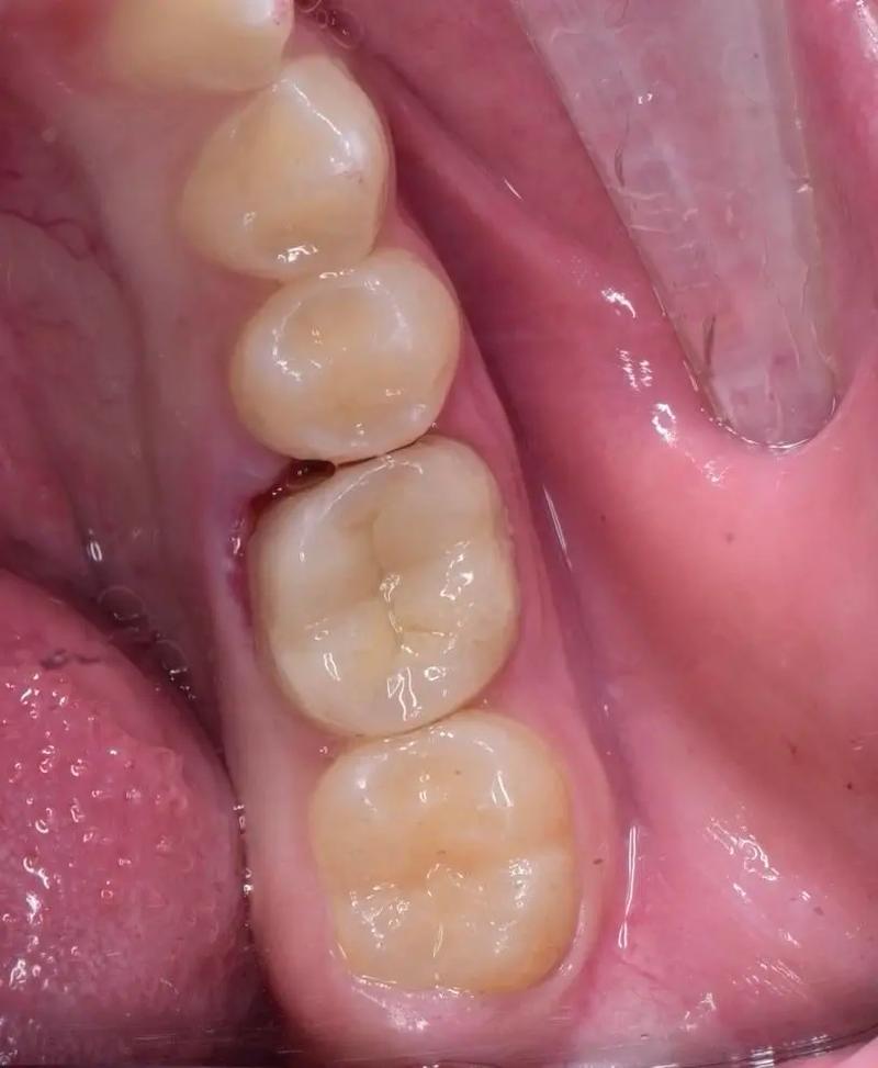 树脂充填后如何正确调合?关键步骤与操作要点是什么?-图1 树脂充填后如何正确调合?关键步骤与操作要点是什么?-图1