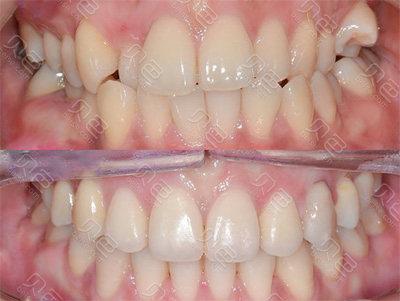 拔牙正畸前后脸型变化图-图3 拔牙正畸前后脸型变化图-图3