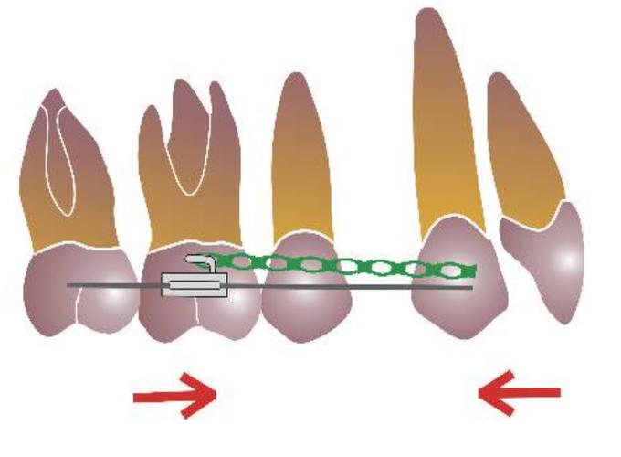正畸关闭拔牙间隙有哪些常用方法?-图1 正畸关闭拔牙间隙有哪些常用方法?-图1