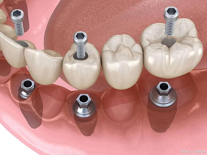 种牙一般选用什么材质的种植体？-图2