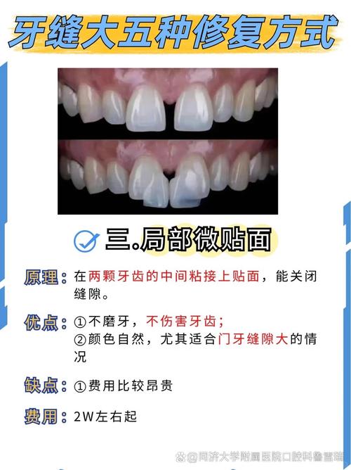 牙稀缝隙大可以种牙么-图1 牙稀缝隙大可以种牙么-图1