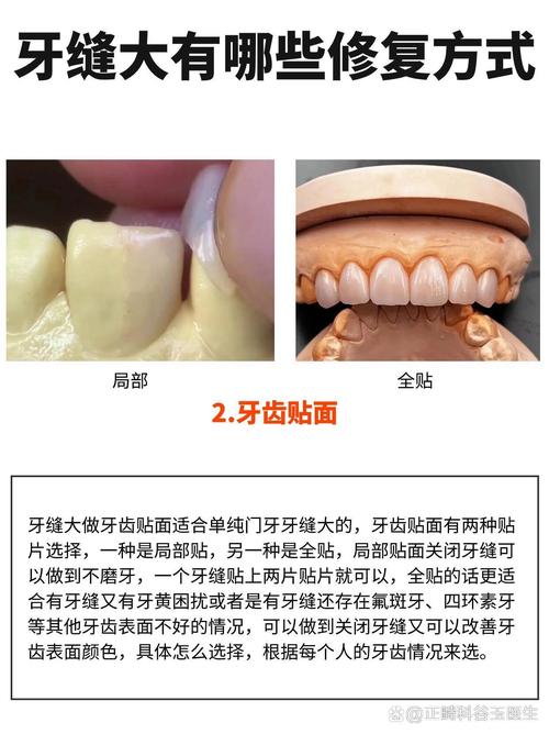 牙稀缝隙大可以种牙么-图2 牙稀缝隙大可以种牙么-图2